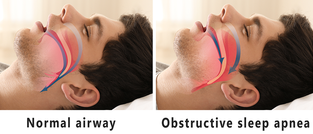 Understanding the Different Types of Sleep Apnea - Lunella™