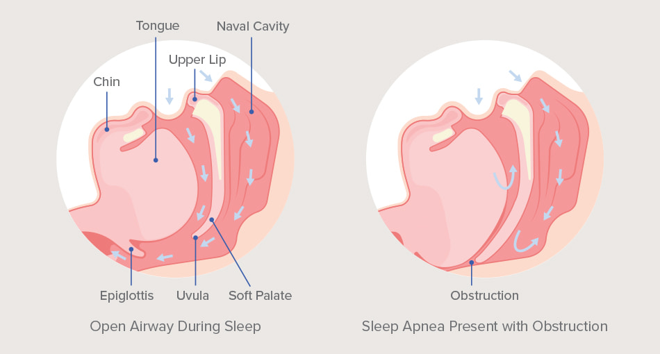 A diagram of a normal open airway and one of a person with obstructive sleep apnea.'