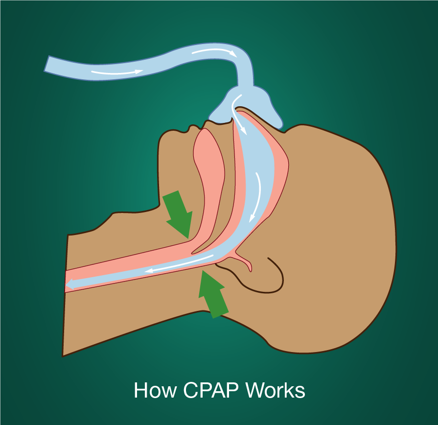 How to Treat Sleep Apnea with CPAP Therapy | SoClean Sleep Talk Blog