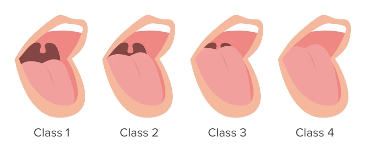 A visual representation of the Mallampati classification.